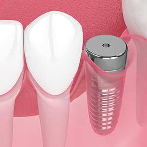 Digital illustration of a dental implant