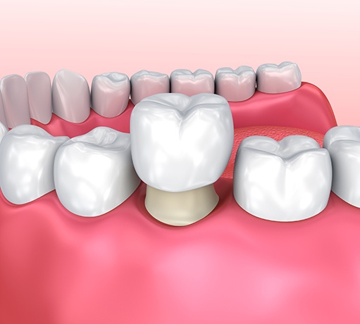 A 3D illustration of a dental crown being placed