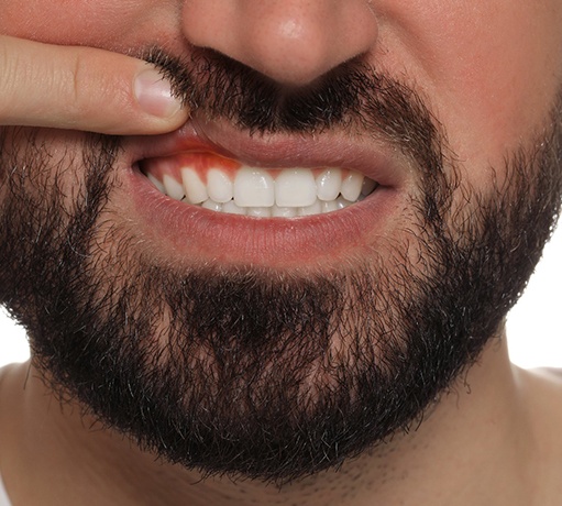 Nose-to-chin view of a man lifting upper lip with one finger to reveal swollen gums